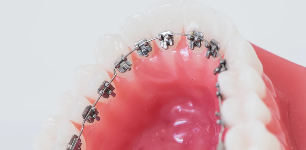 Orthodontie de l’adulte à Lille 59000